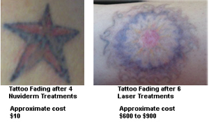 A Nuviderm Faded Tattoo Compared to a Laser Faded Tattoo